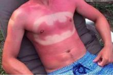 La mode du Sunburn Art.